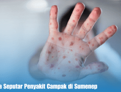 Daftar Fakta Seputar Penyakit Campak di Sumenep